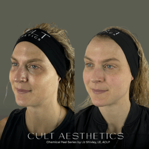 Blonde woman before and after from getting VI Peel