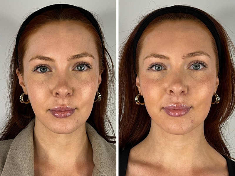 Before and after photo - Biostimulators