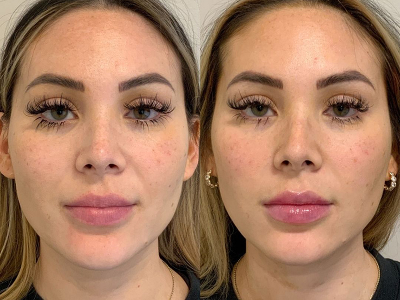 Before and after photo - Microneedling