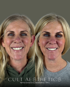 before/after Neurotoxins (Tox)