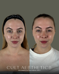 Exoglow Microneedling before and after