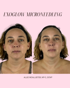 Exoglow Microneedling: The Ultimate Refresh
