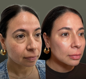 Treatment Spotlight: Signature Full Facial Balancing