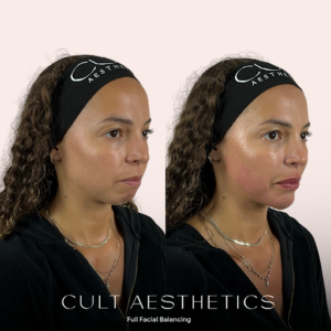 Facial Balancing: The Ultimate Injectable Refresh before and after