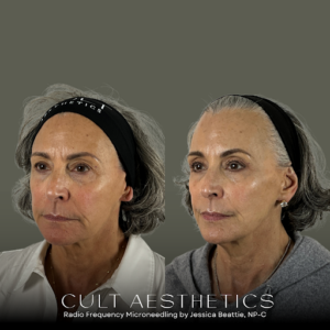 Sylfirm RF Microneedling: The Structural Smoother